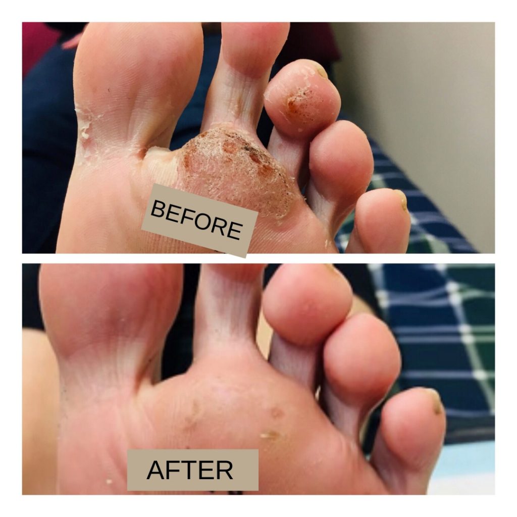 Swift MICROWAVE THERAPY FOR VERRUCA LESIONS