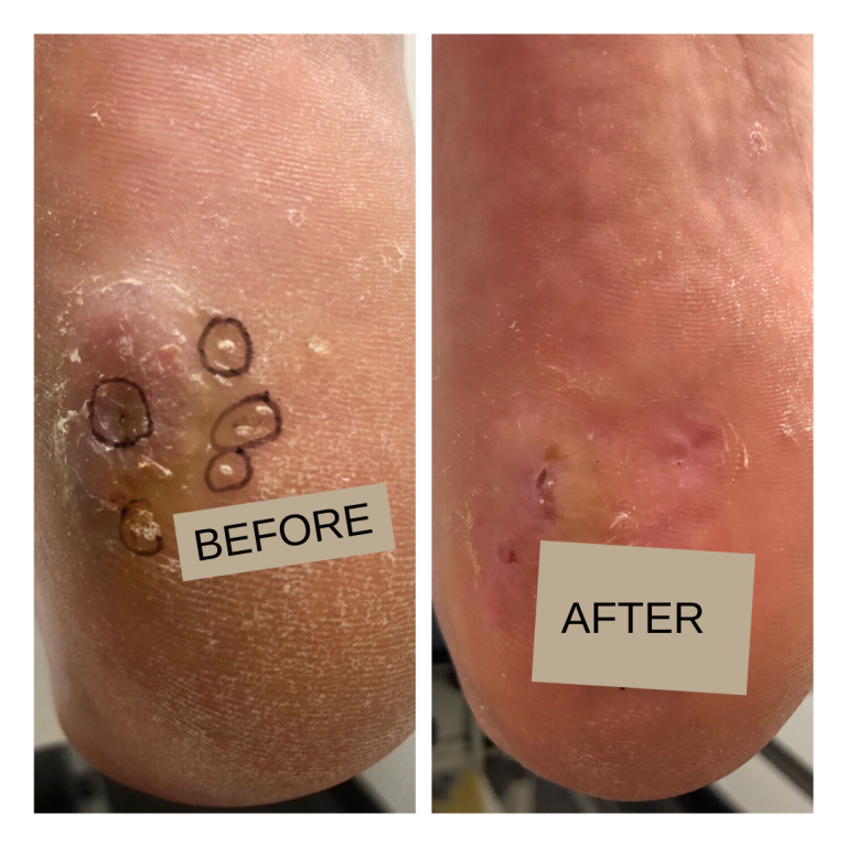 Swift MICROWAVE THERAPY FOR VERRUCA LESIONS