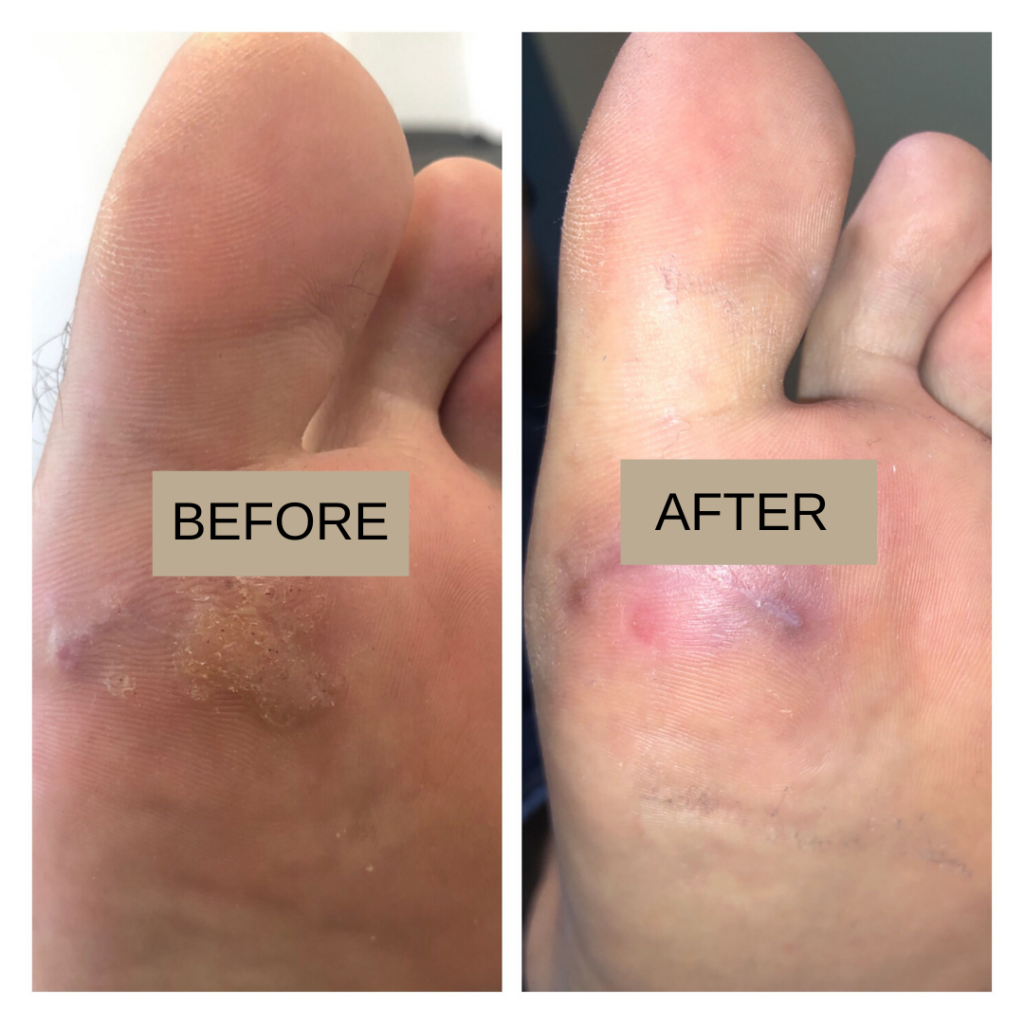 Swift MICROWAVE THERAPY FOR VERRUCA LESIONS