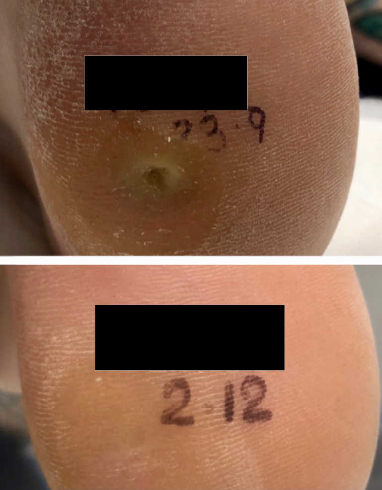 Swift MICROWAVE THERAPY FOR VERRUCA LESIONS