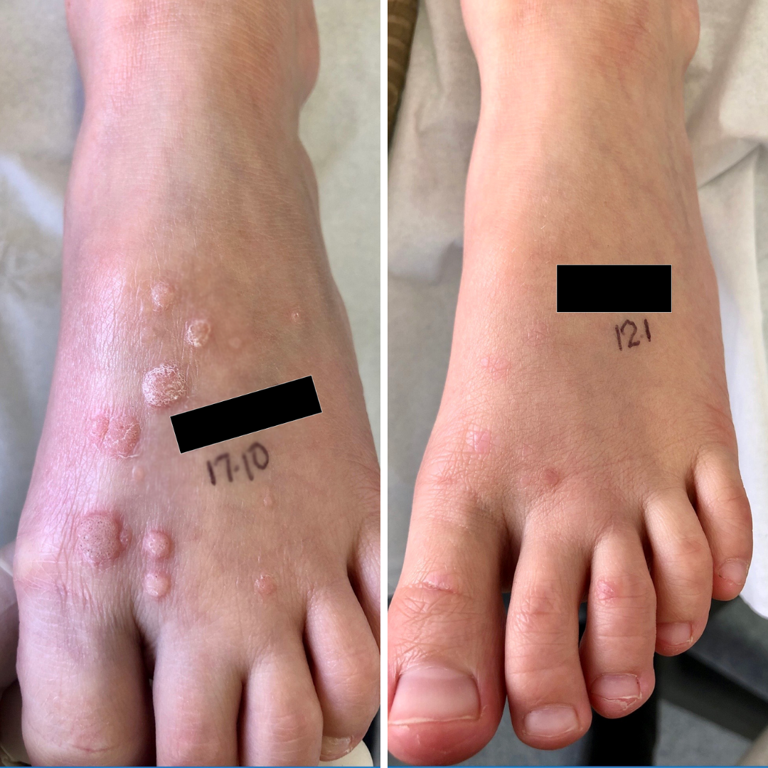 Wart Removal Sydney Swift Plantar Wart Removal