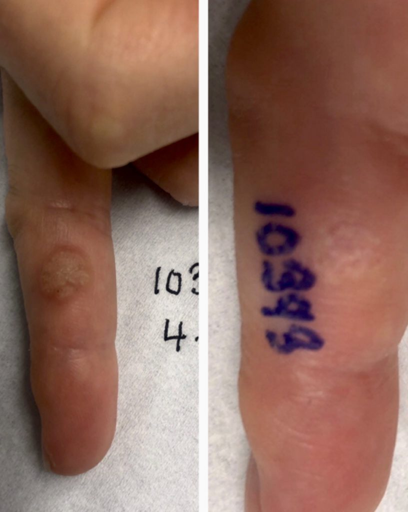 Wart Removal Sydney Swift Plantar Wart Removal