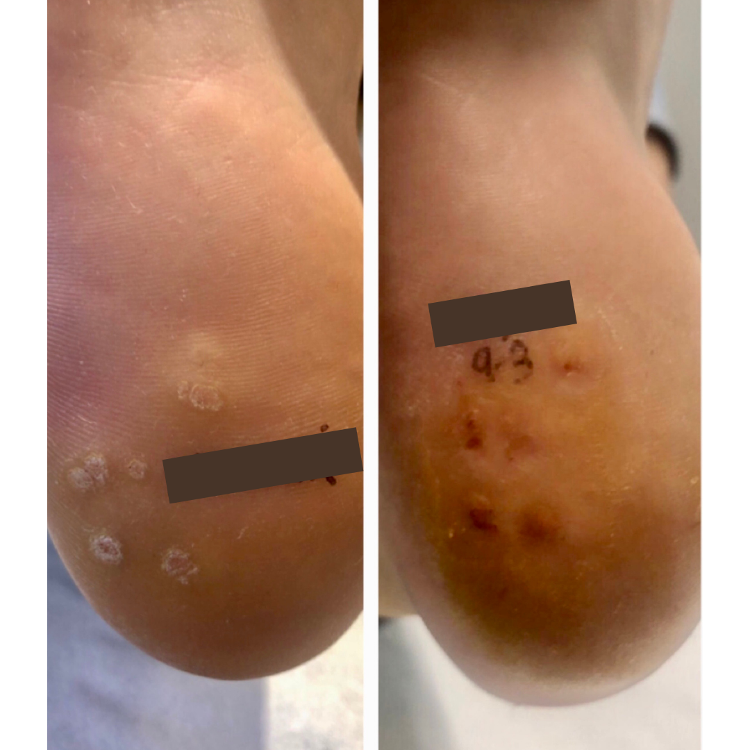 Wart Removal Sydney Swift Plantar Wart Removal