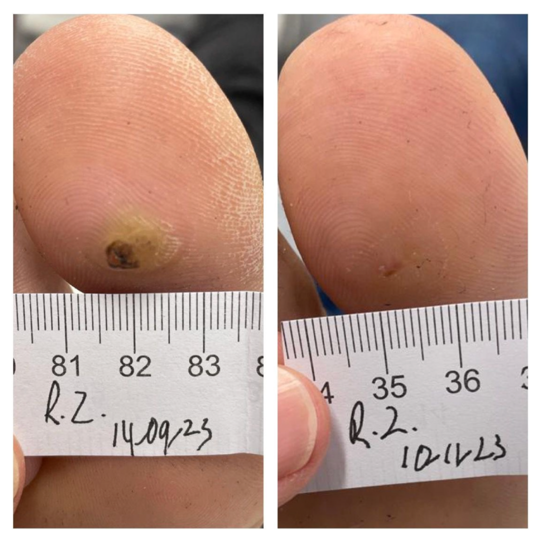Wart Removal Sydney Swift Plantar Wart Removal