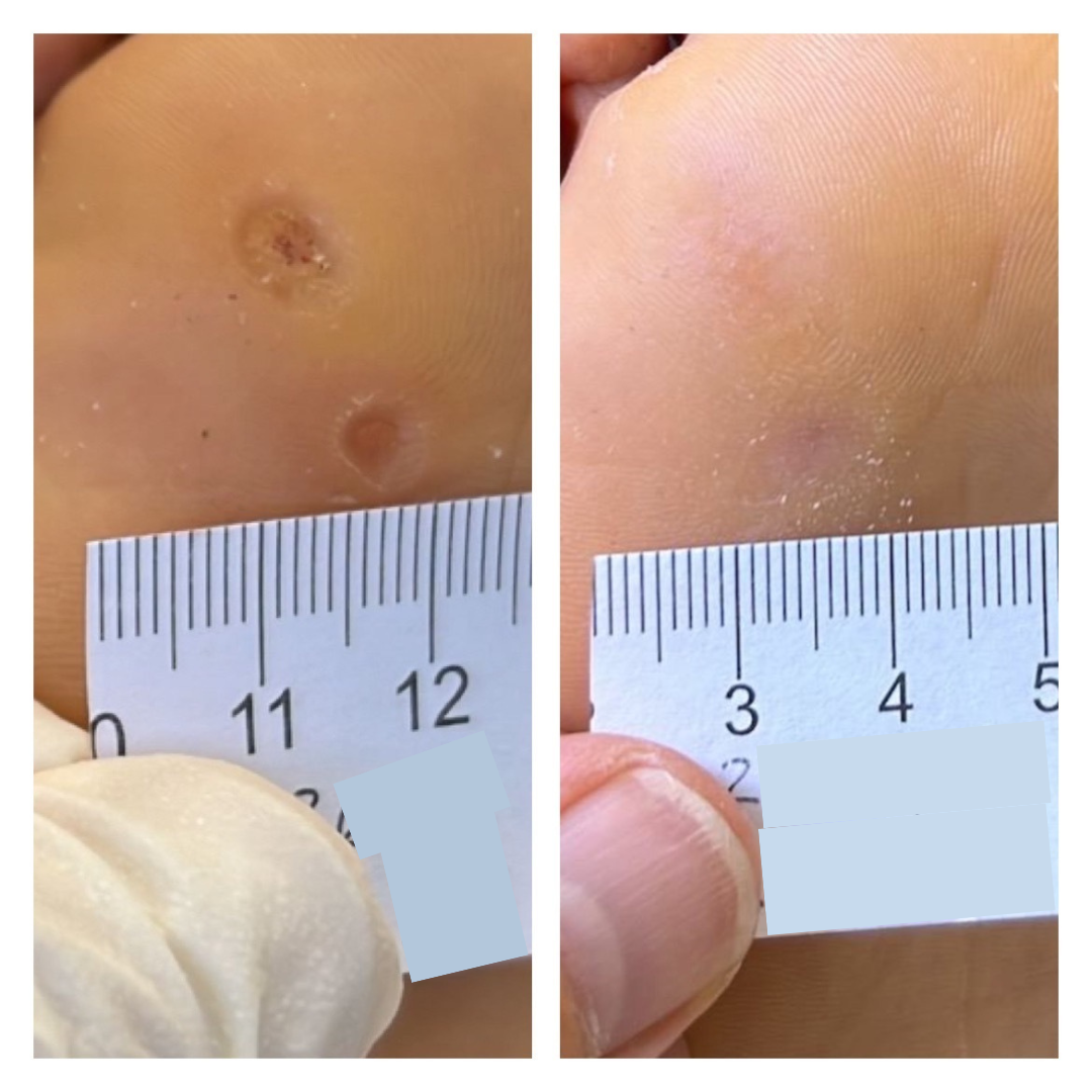 Wart Removal Sydney Swift Plantar Wart Removal